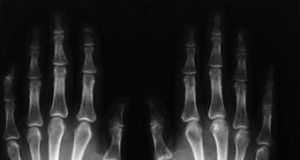 Enfermedad de Pager radiografia1