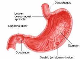 stomach_ulcers