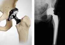 images_protesis