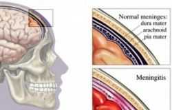 300px-meninges_diagram-2