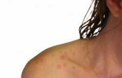 Homeopatía en Urticarias ashleigh-morris-water-allergy-picture4