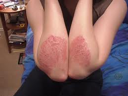 Que es la psoriasis images-9