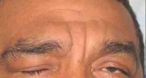paralisis_facial_2_webdelprofesor-ula-ve