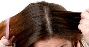 cabello_caspa1