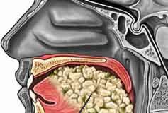 cancer_oral_bucal_lengua_piso1