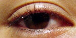 blefaritis_cronica1