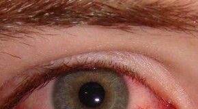 conjuntivitis-290x2901