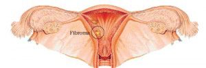 fibroma-2