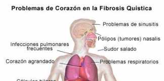 fibrosisquistica