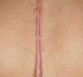 keloid
