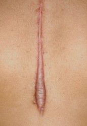 keloid