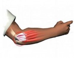 Homeopatía para epicondolitis wsb_342x271_ft_codo-tenista012