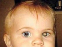 Retinoblastoma1