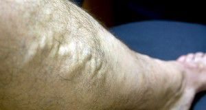 varices1