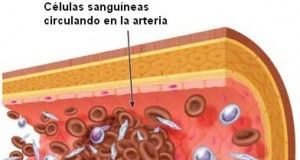 wpid-arteriosclerosis1