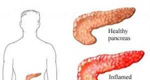 Pancreatitis1