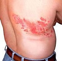 culebrilla1