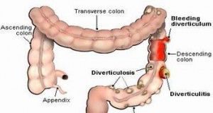 diverticulitis1