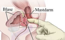 prostata_untersuchung_677-2