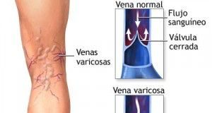 varices1