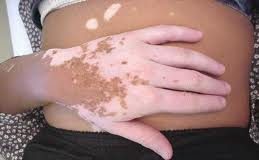 Cvitiligo