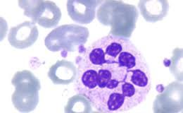 anemiaperniciosa