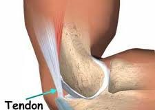 bursitis