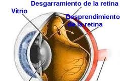 desprendimientoretina