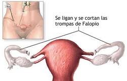 ligadura-de-trompas