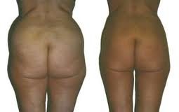liposuccion