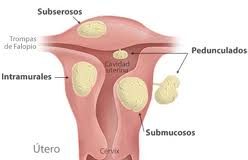 miomauterino1
