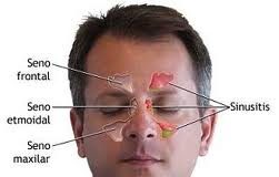 sinusitis-consejos