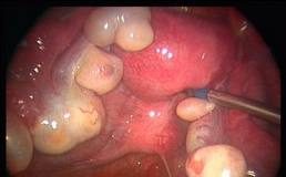 teratoma_ovarico