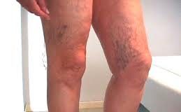 tromboflebitis