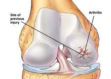 Arthrosischip