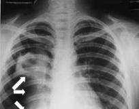Conoce-la-tuberculosis-pulmonar