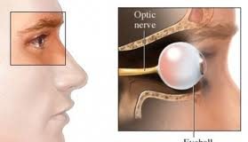 En-que-consiste-la-neuritis-optica