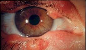 Has-sufrido-alguna-vez-blefaritis