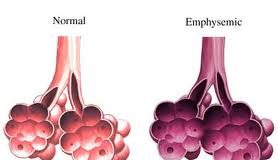 enfisema