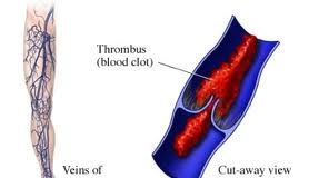 flebittis