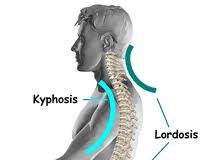 lordosis
