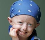 progeria