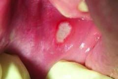 El-sindrome-de-Behcet