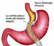 bypass