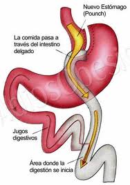 bypass