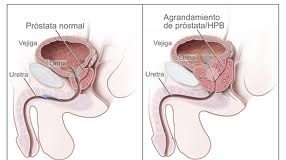 cancerprostata1