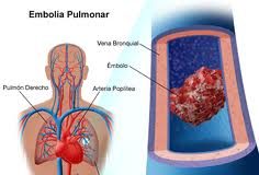emboliapulmonar