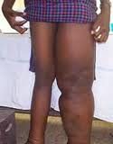 filariasis