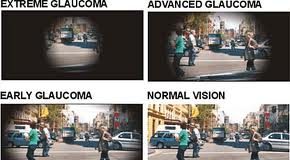galucoma