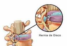 herniadiscal